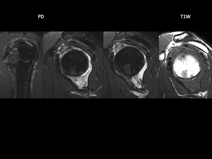 Figure 4 for case tendon of long head of biceps brachii ( RID1944 )